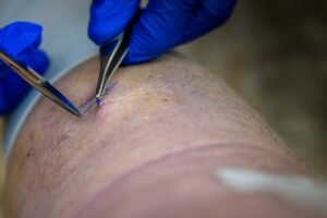 Photo Knee arthroscopy